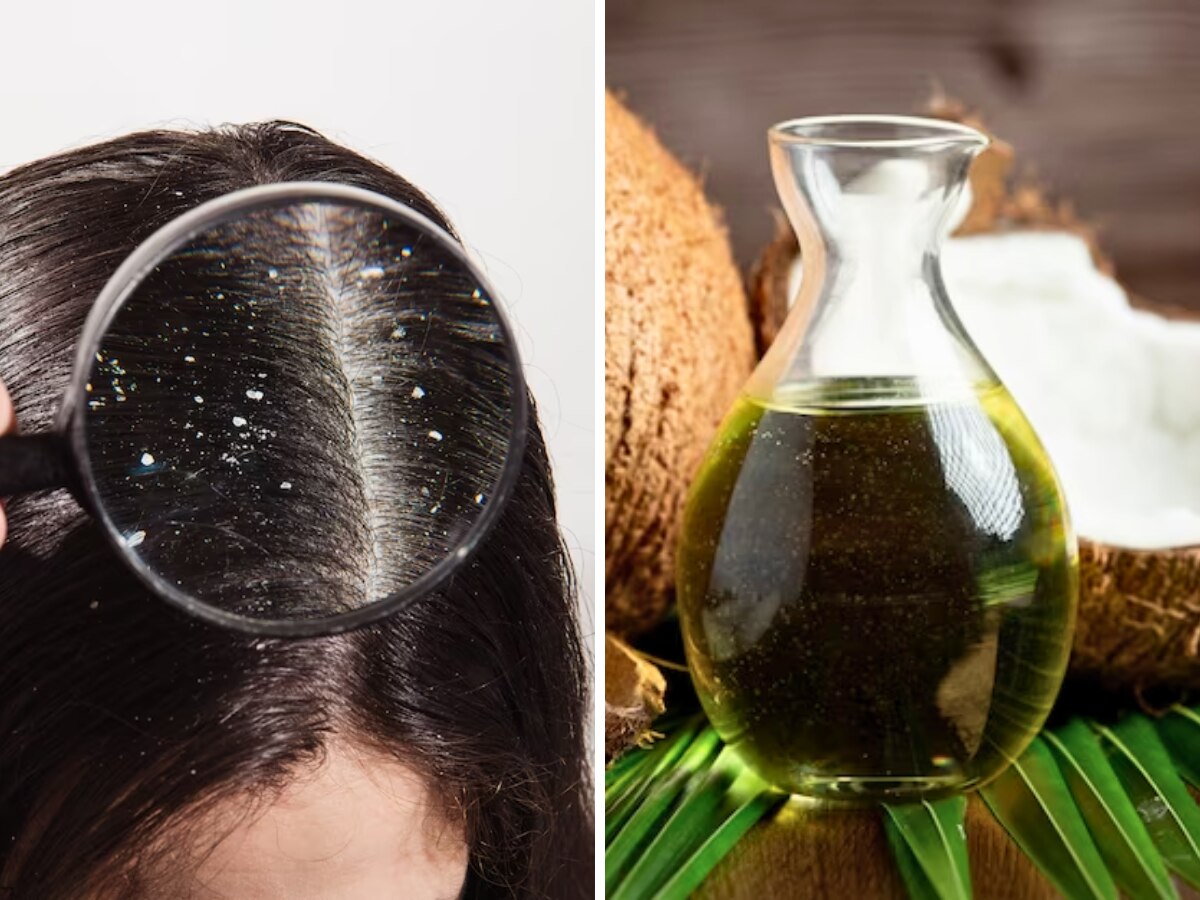 Dandruff को जड़ से खत्म कैसे करें? सस्ते में चाहिए अच्छा रिजल्ट तो ट्राई करें ये घरेलू उपाय