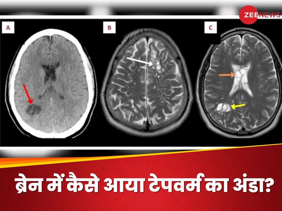 52 साल के शख्स को हुई माइग्रेन की शिकायत, ब्रेन में मिला टेपवर्म का अंडा, क्या ये फूड खाने से हुई बीमारी?