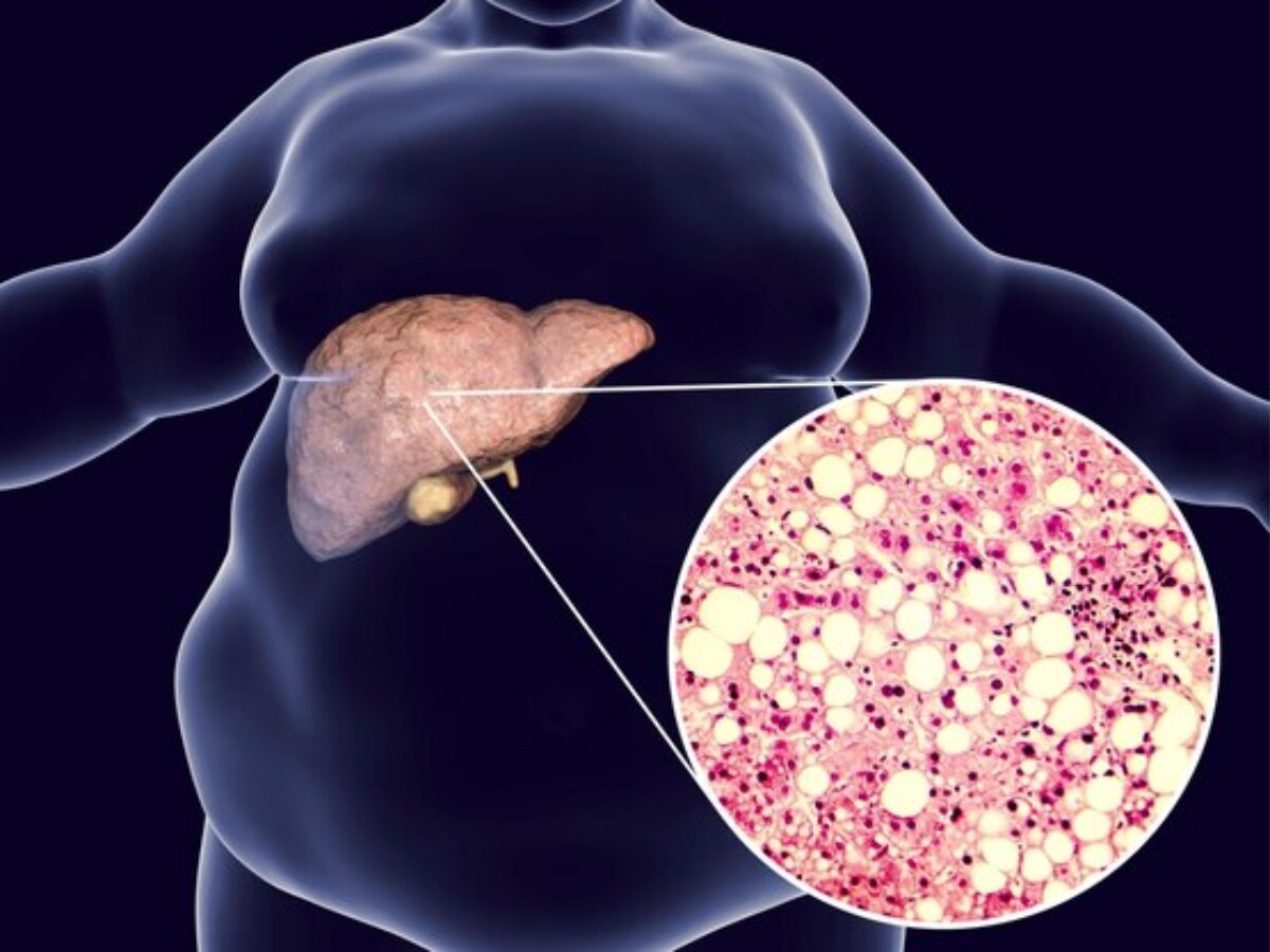 Ayurvedic Herb For Liver: लिवर में जमी चर्बी के लिए ये 3 जड़ी-बूटी हैं रामबाण उपाय, एक्सपर्ट ने बताया Fatty Liver में कैसे करें सेवन