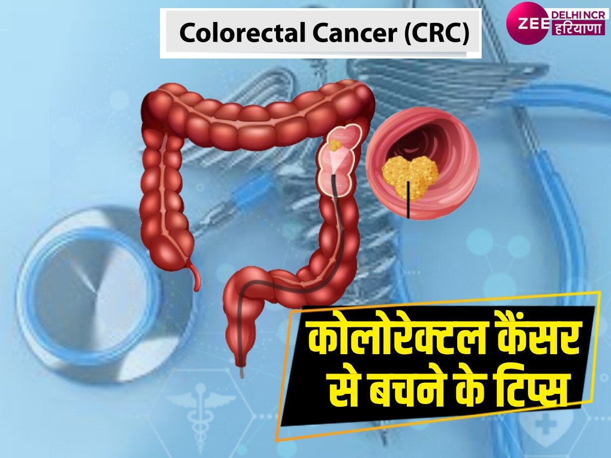 Colorectal Cancer: पूरा देश मना रहा कोलोरेक्टल जागरूकता माह, एक्सपर्ट से जानिए इससे बचने के 5 टिप्स