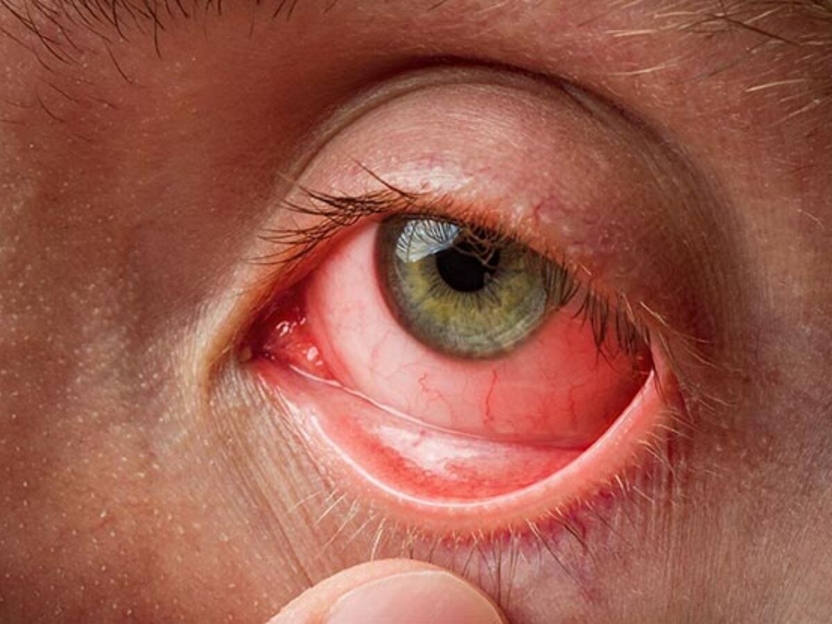 Conjunctivitis: जाने क्या होता है कंजंक्टिवाइटिस. क्या होते है उसके कारण और लक्षण?