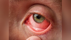 Conjunctivitis: जाने क्या होता है कंजंक्टिवाइटिस. क्या होते है उसके कारण और लक्षण?