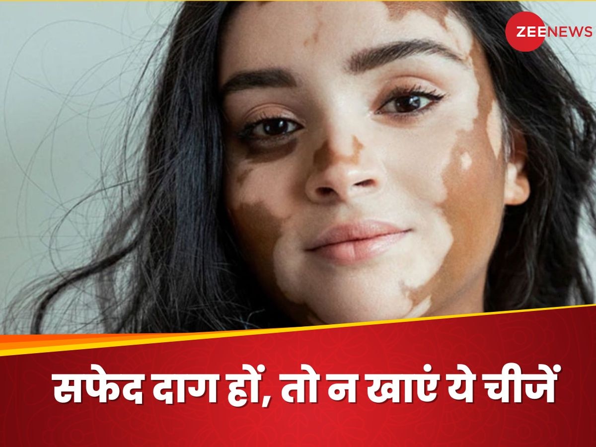 Vitiligo: सफेद दाग से हैं परेशान, तो न खाएं ये चीजें, बढ़ सकते हैं व्हाइट पैचेज