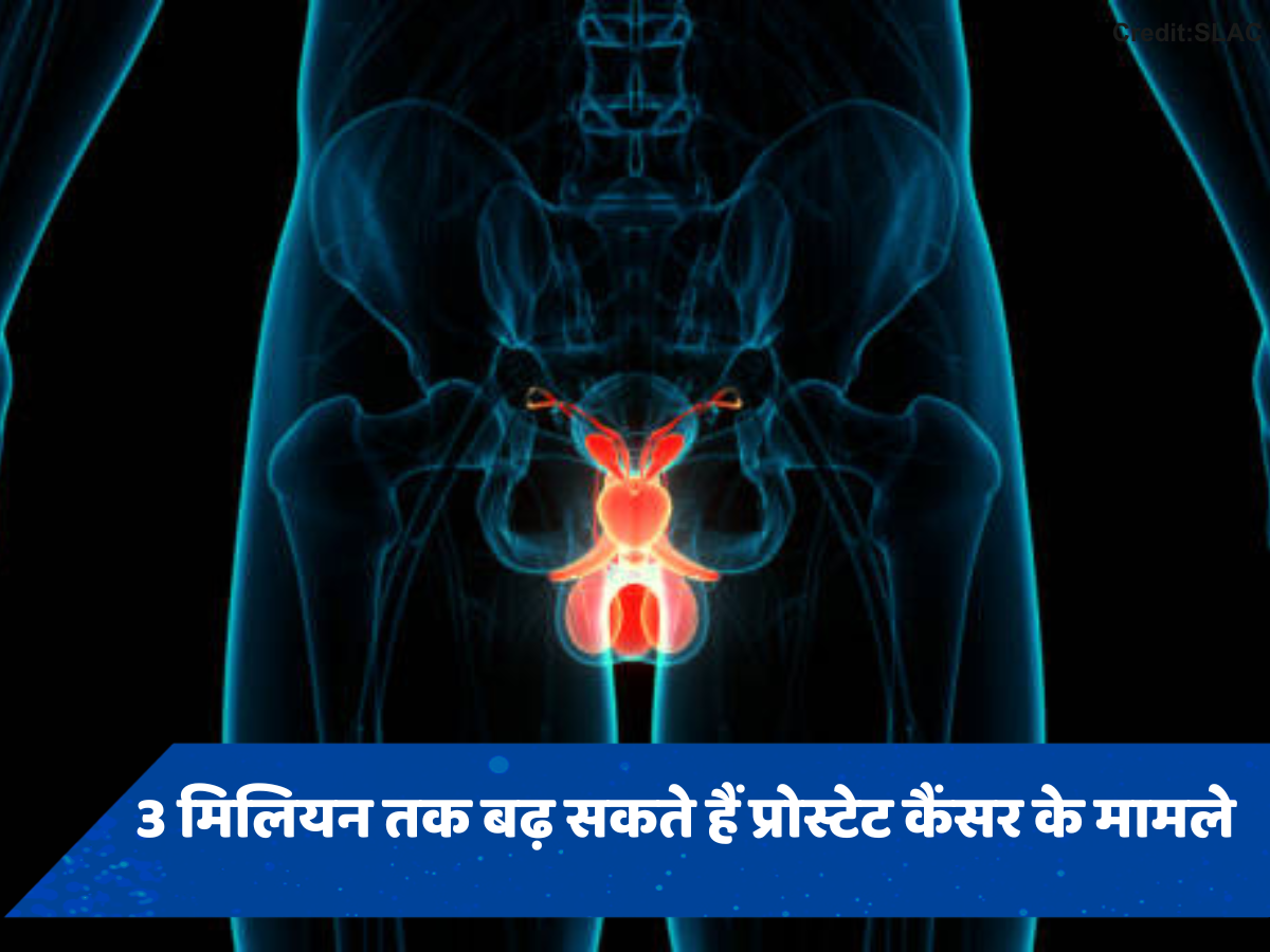 2040 तक दोगुने हो सकते हैं प्रोस्टेट कैंसर के मामले, 85% तक पहुंच सकता है मौत का खतरा