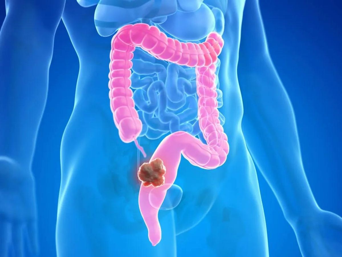 Colon Cancer: ज्यादा मीट खाने वाले हो जाएं सतर्क, बढ़ सकता है कोलन कैंसर का खतरा