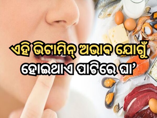 Vitamin and Mouth ulcers