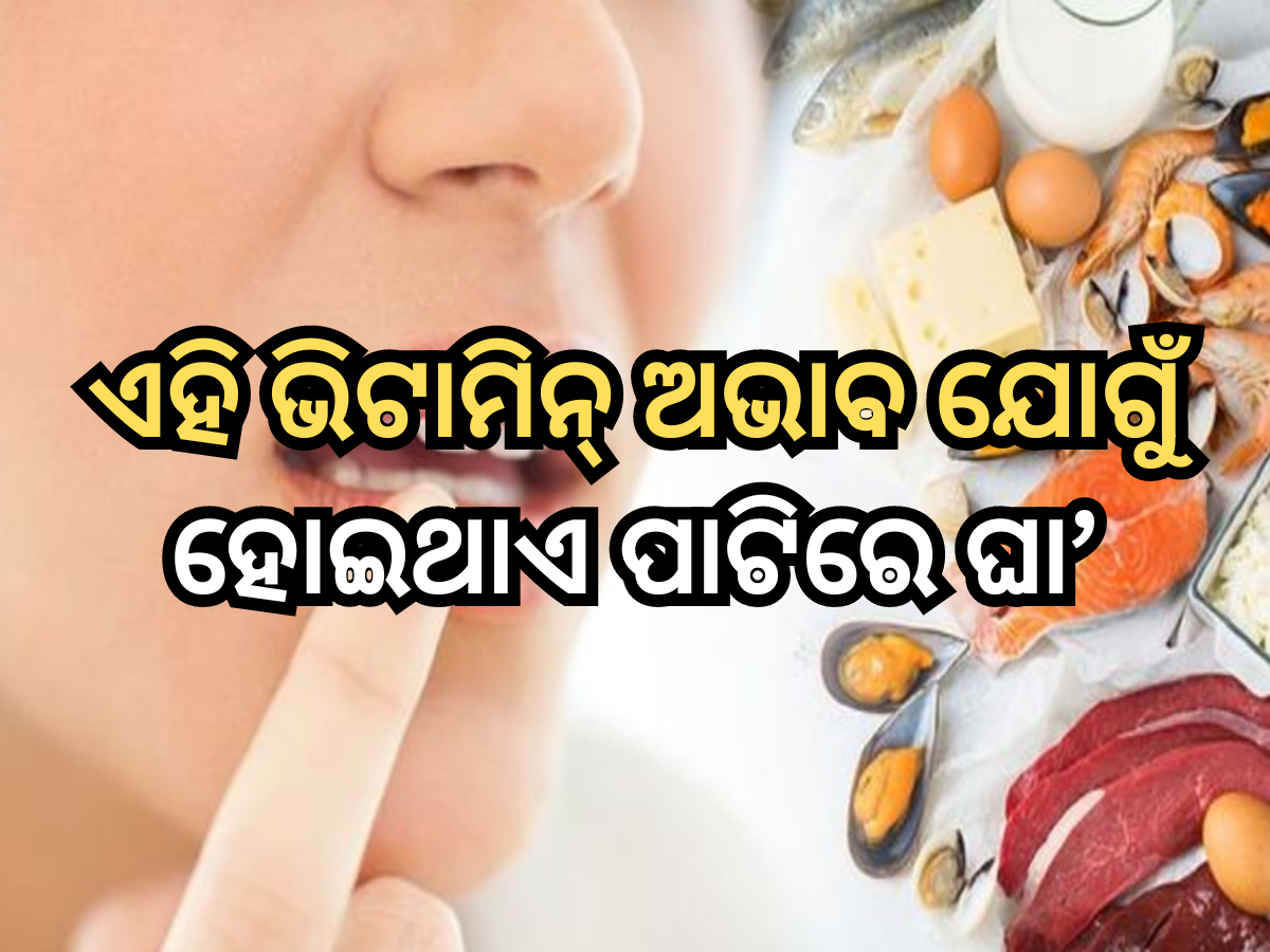 Vitamin and Mouth ulcers Vitamin and Mouth ulcers