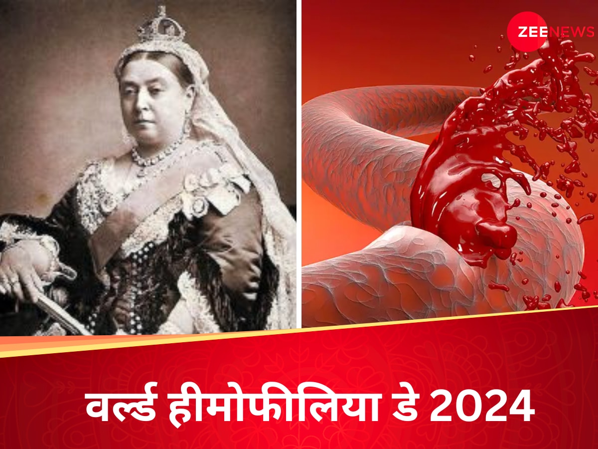 World Hemophilia Day: इंग्लैंड क्वीन विक्टोरिया को भी थी खून को पानी बना देने वाली ये बीमारी, ऐसा हो जाता है हाल