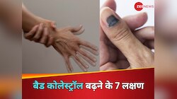 हाथों-उंगलियों में दिख रहे ये 7 लक्षण तो जान लें बढ़ गया है शरीर में बैड कोलेस्ट्रॉल