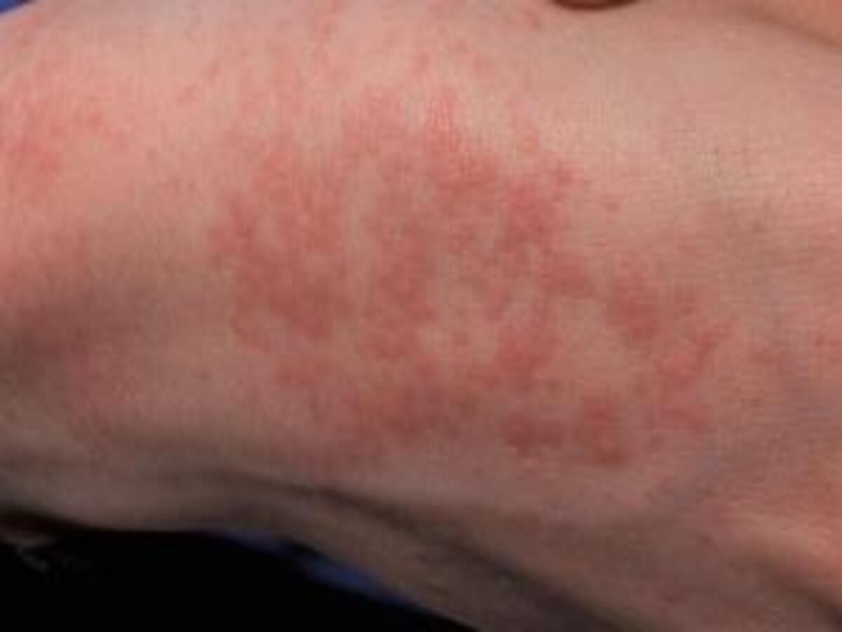 How to Prevent and Treat Common Summer Rashes What is the skin disease ...