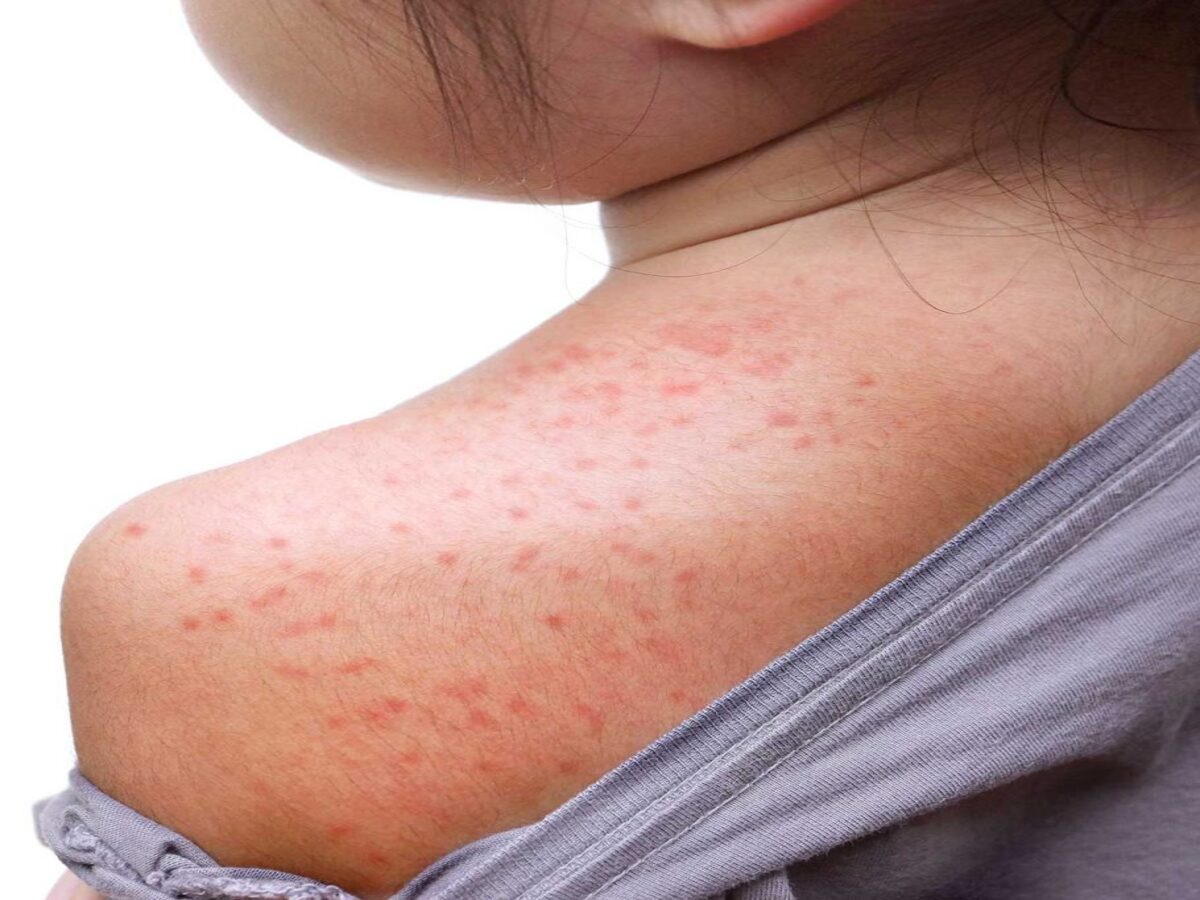How to Prevent and Treat Common Summer Rashes What is the skin disease ...