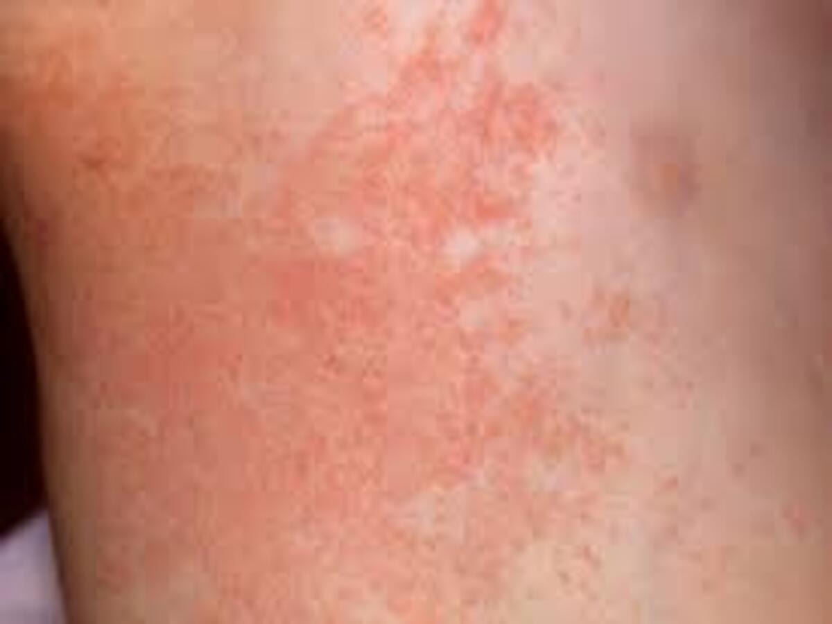 How To Prevent And Treat Common Summer Rashes What Is The Skin Disease