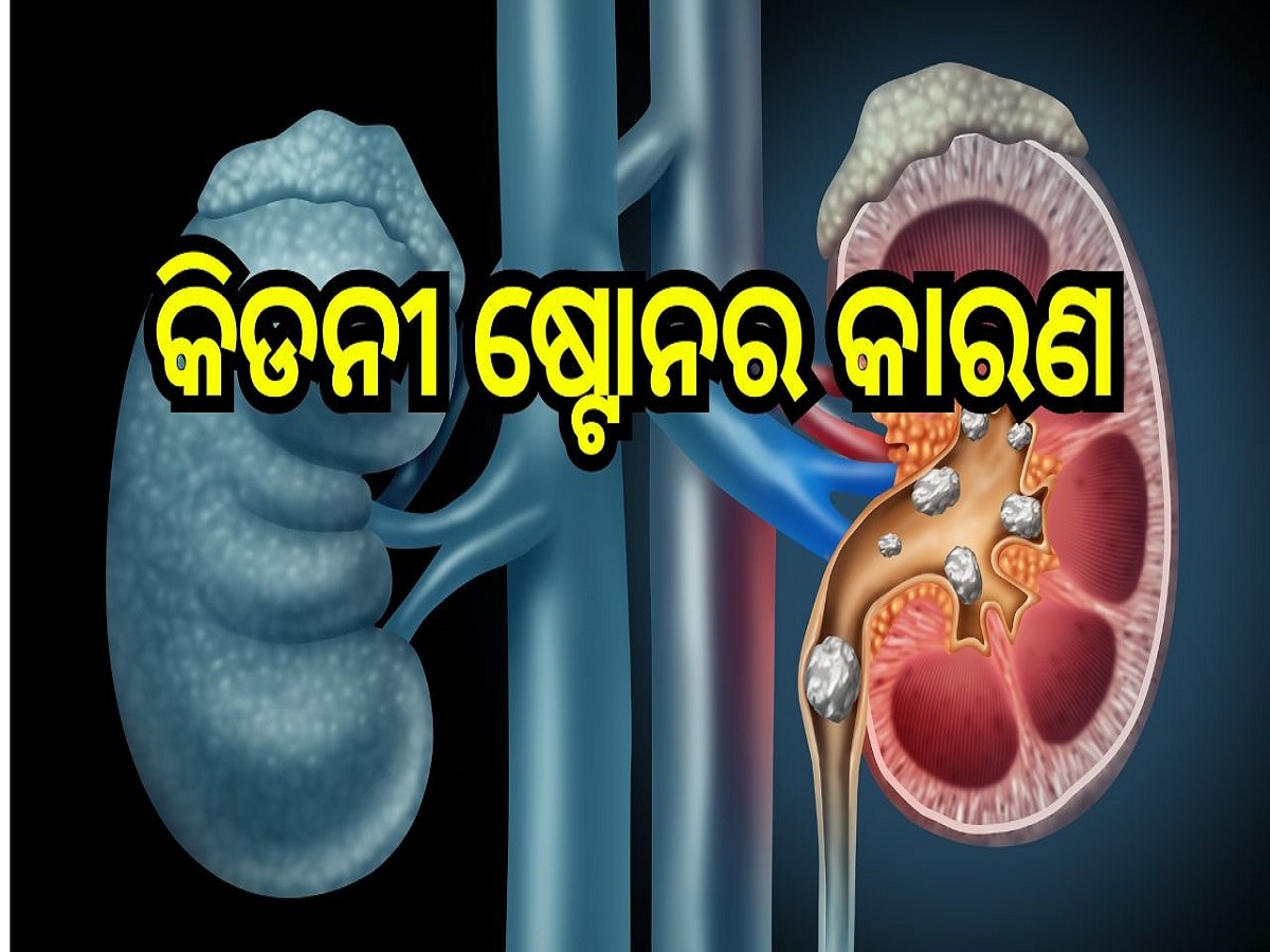 Kidney Stone: ଏହି ସବୁ କାରଣ ପାଇଁ ହୋଇଥାଏ କିଡନୀ ଷ୍ଟୋନ୍