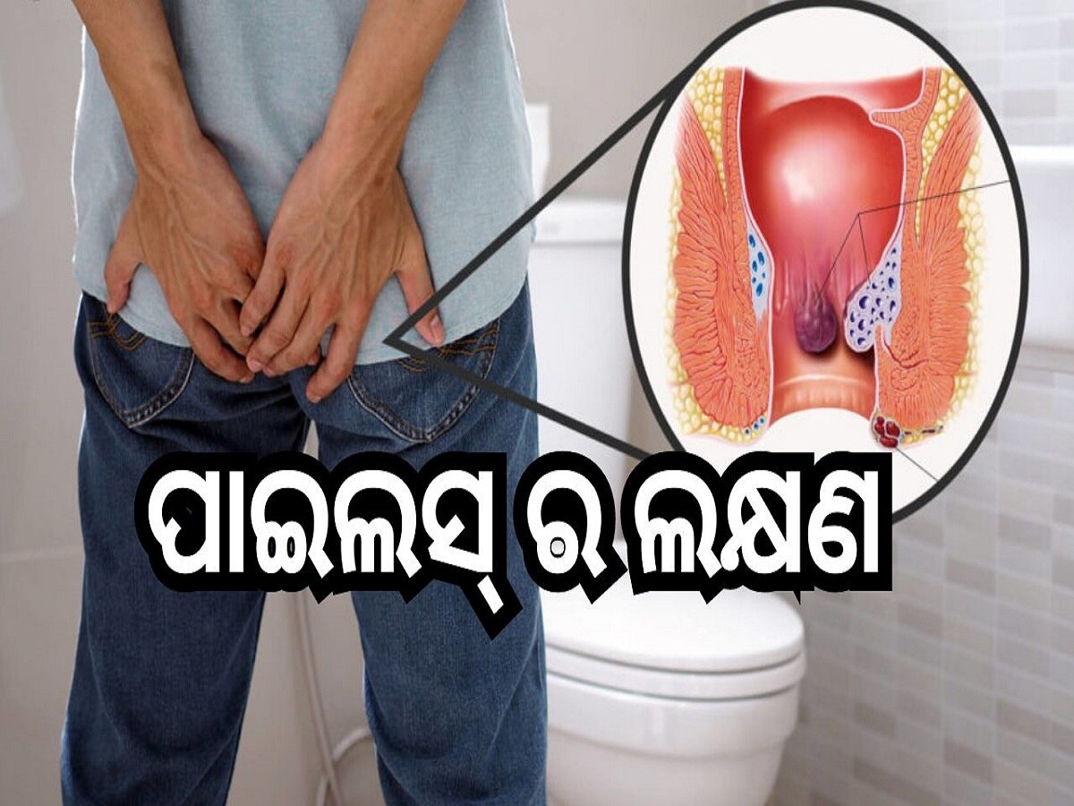 Piles Symptoms: ପାଇଲସ୍ ହେବା ପୂର୍ବରୁ ଶରୀରରେ ଦେଖା ଦେଇଥାଏ ଏହି ସବୁ ଲକ୍ଷଣ...