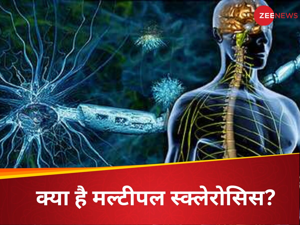 World Multiple Sclerosis: सबसे खतरनाक ऑटोइम्यून डिजीज मल्टीपल स्क्लेरोसिस, न्यूरोलॉजिस्ट ने बताया दिमाग-रीढ़ होने लगता है कमजोर; जानें लक्षण बचाव के उपाय