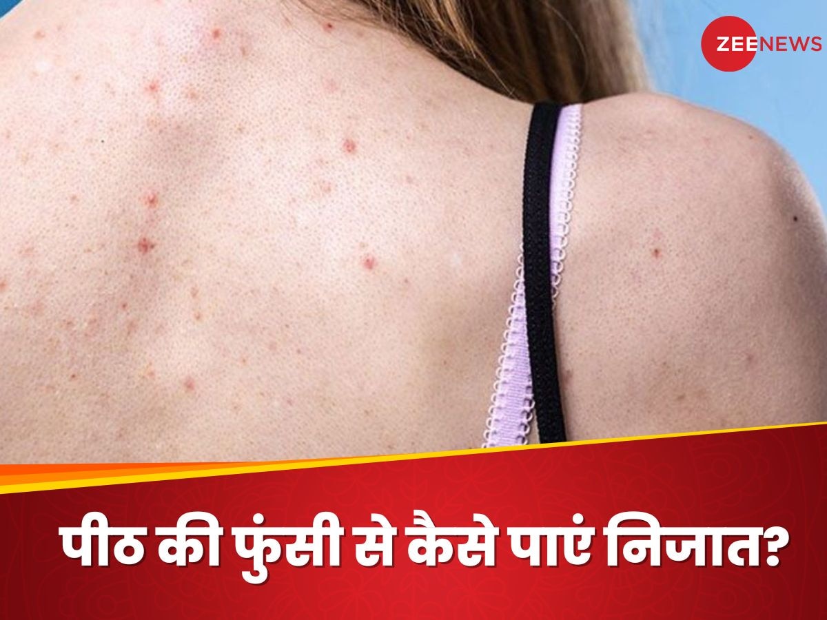 Back Acne: पीठ की फुंसी के कारण नहीं पहन पा रही हैं बैकलेस ड्रेस? इन चीजों की मदद से दूर करें दाने