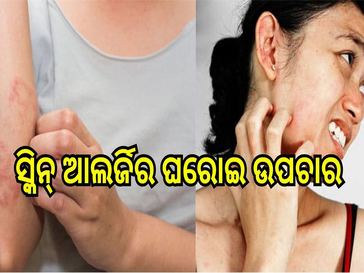 Skin Allergies: ଖରାଦିନେ ସ୍କିନ୍‌ ଆଲର୍ଜିର ଘରୋଇ ଉପଚାର