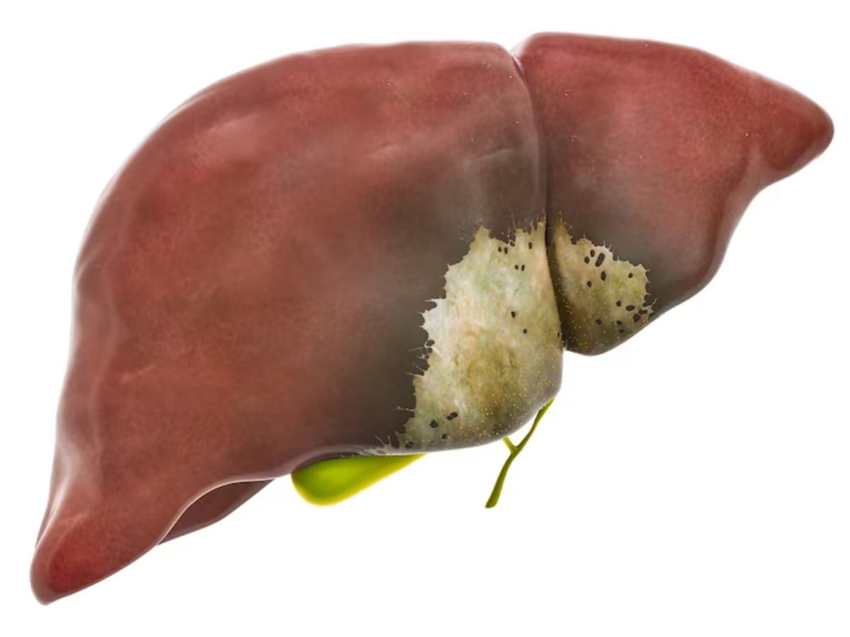 Fatty Liver: सिर्फ शराब ही नहीं, मीठा भी बढ़ा सकता है फैटी लिवर का खतरा, कैसे कम करें रिस्क?