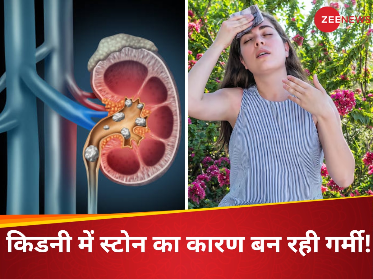 किडनी के लिए काल बनी दिल्ली की गर्मी, Kidney Stone के दर्द से कराह रहे 40% युवा; जानें आपको बचाव के लिए क्या करना है