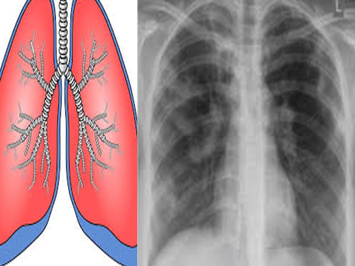 राजस्थान में यहां से TB बीमारी को लेकर सुखद खबर, जांच की संख्या बढ़ाने के बाद भी साल दर साल टीबी के मरीजों में हो रही कमी