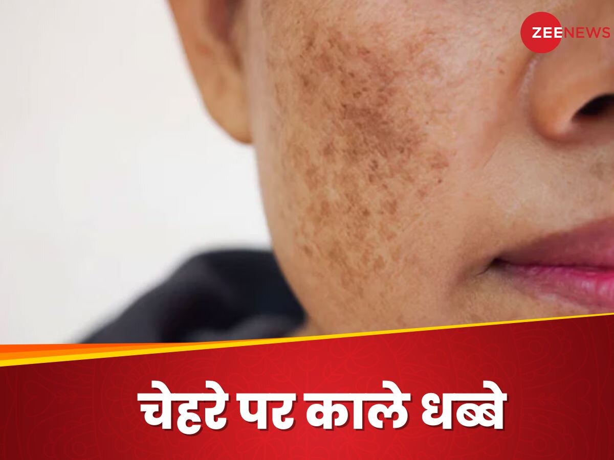 Dark Spots: चेहरे पर आते हैं काले धब्बे? तो रोकने के लिए तुरंत बदलें अपनी 4 आदतें