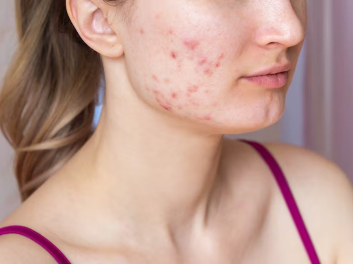 Acne Scars Remedy: मुहांसों के दाग-धब्बों से भर गया है चेहरा, स्पॉटलेस स्किन के लिए ट्राई करें ये 5 चीजें