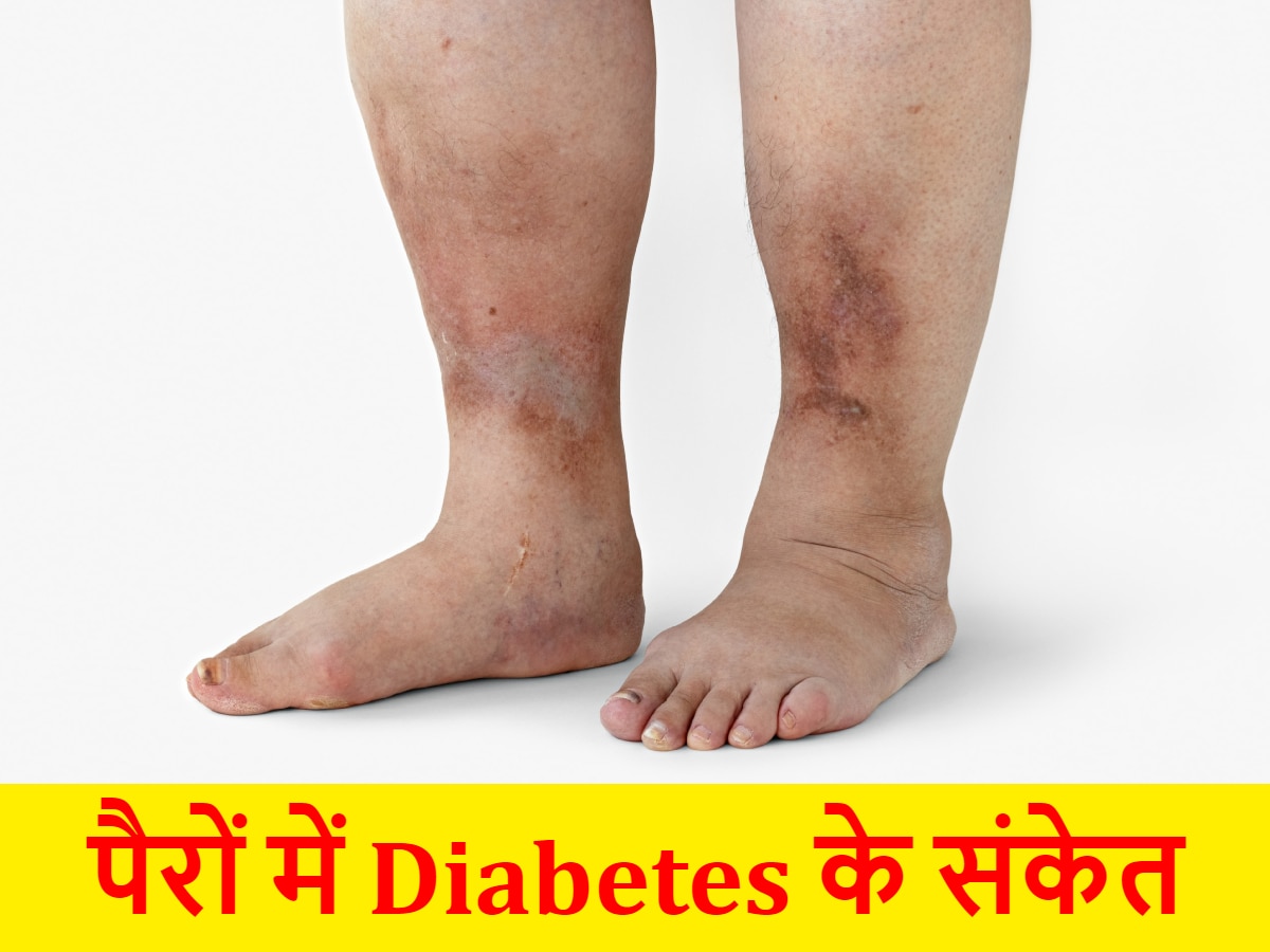 Diabetes Symptoms: पैरों में इस तरह मिलते हैं डायबिटीज के चेतावनी संकेत, एक्सपर्ट ने बताया कब करवाएं शुगर टेस्ट