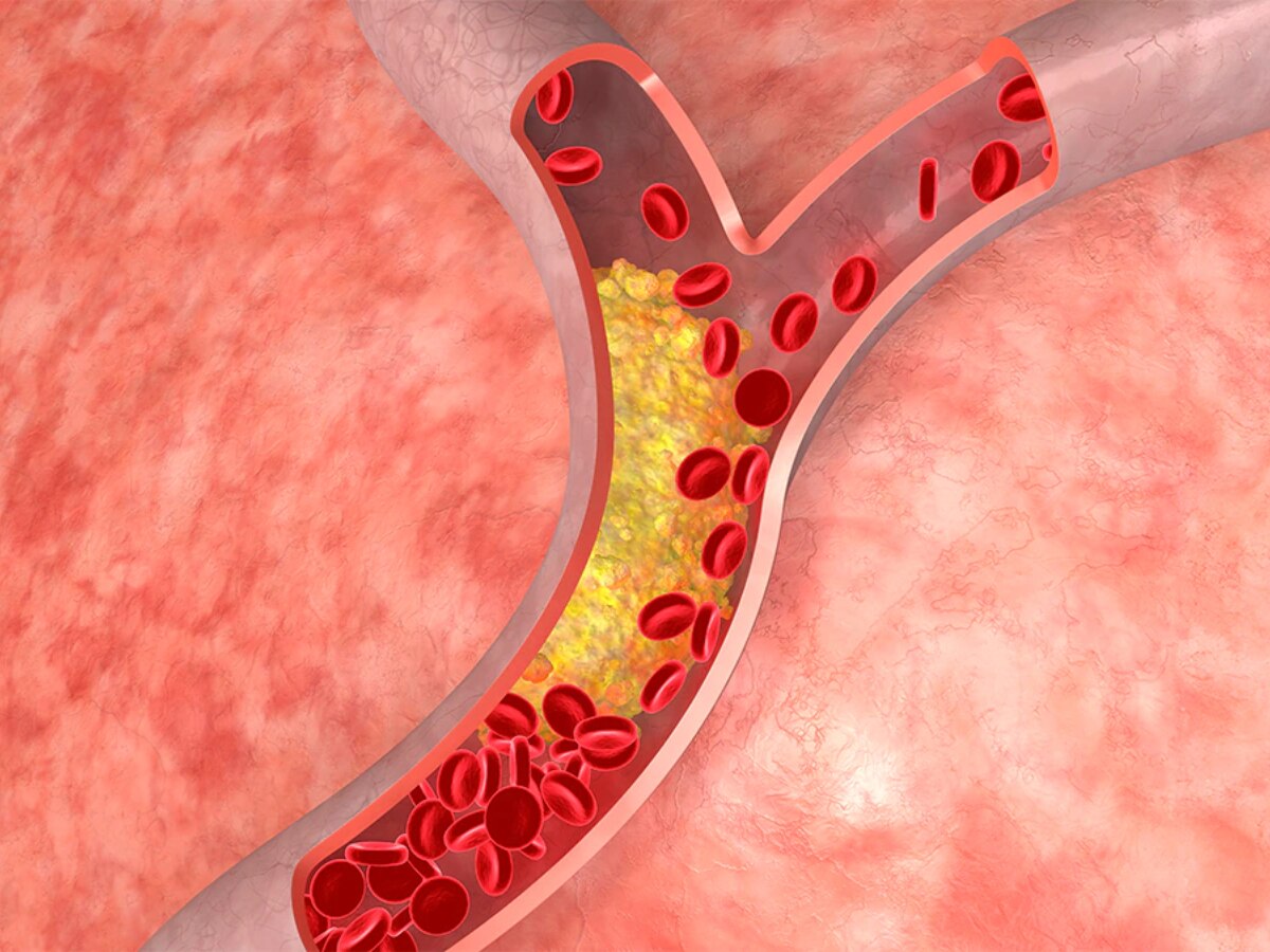 High Cholesterol: कोलेस्ट्रॉल घटाना चाहते हैं तो भूलकर भी न खाएं ये चीजें, डॉक्टर ने दी चेतावनी