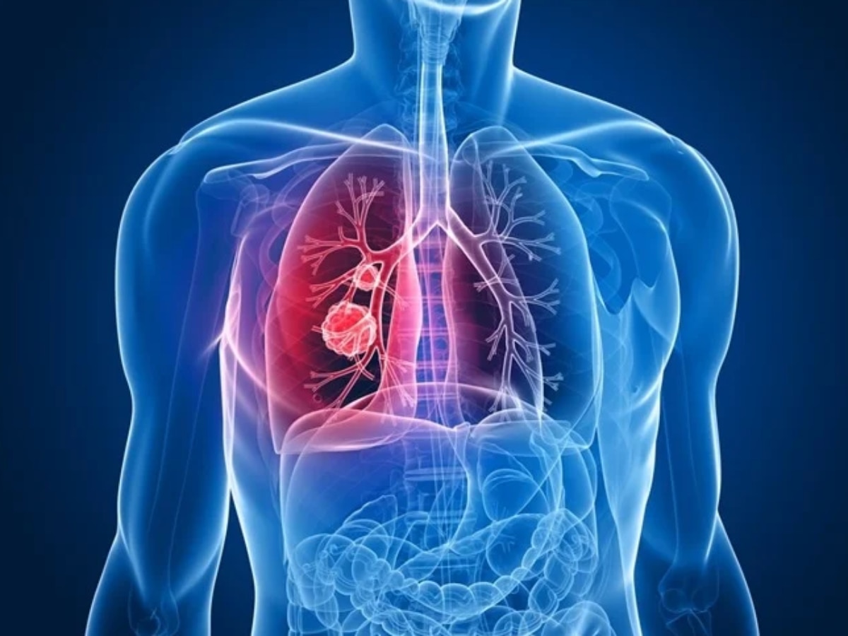 Lung Cancer: भारत में फेफड़ों के कैंसर का चौंकाने वाला ट्रेंड, धूम्रपान न करने वाले भी हो रहे शिकार; स्टडी में सामने आई ये बड़ी वजह