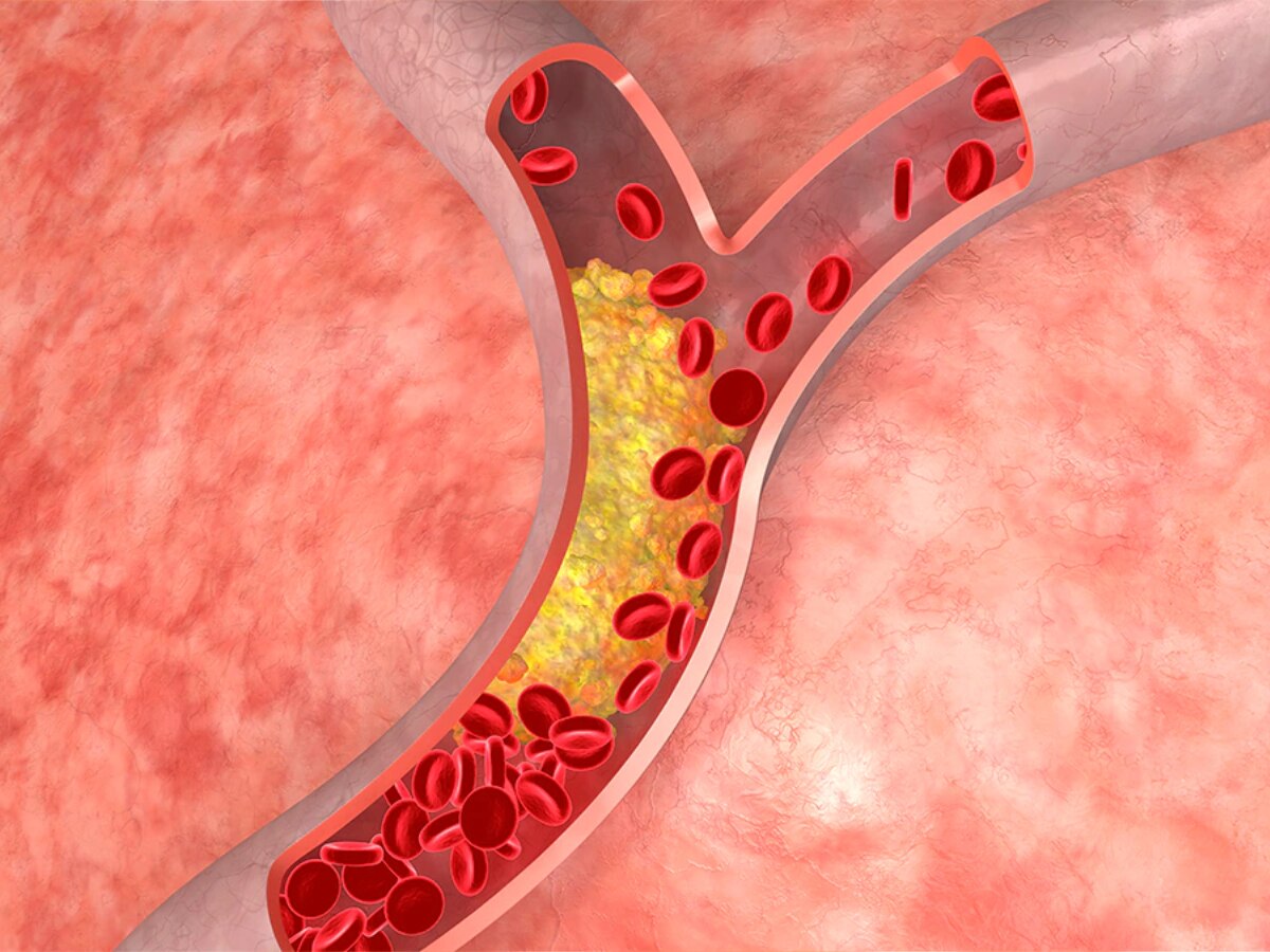 न फास्टफूड, न बैड लाइफस्टाइल... भारतीयों में हाई कोलेस्ट्रोल ज्यादा होने की ये है बड़ी वजह