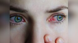 मानसून में होने वाले 5 कॉमन Eye Infection, ये लक्षण दिखते ही करवाएं डॉ. से जांच