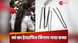 मां का हेयर क्लिप निगल गया 10 साल का बच्चा, जब घरवालों ने देखा तो अटक गई सांसें