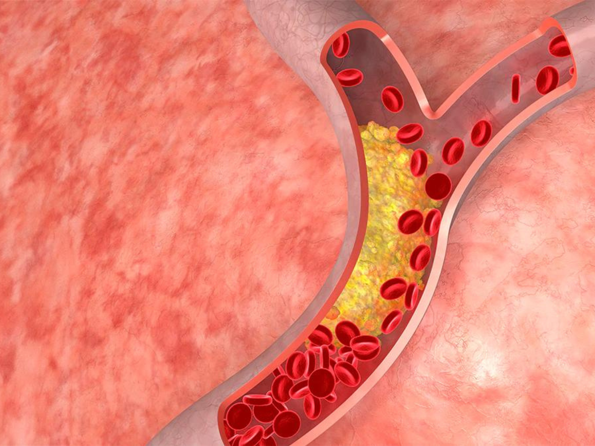कोलेस्ट्रॉल कम करें