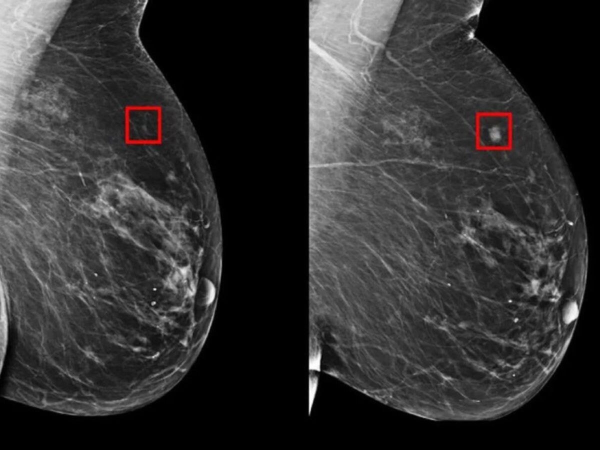 ब्रेस्ट कैंसर होने से 5 साल पहले ही AI ने लगाया पता, नई खोज ने बढ़ाई उम्मीद