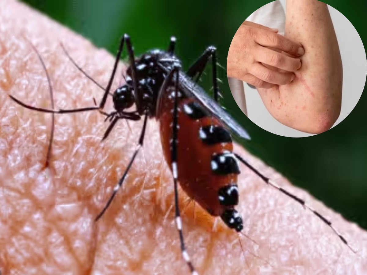 Dengue Symptoms: डेंगू में सबसे पहले नजर आते हैं ये 7 लक्षण, पहचान लिया तो अस्पताल में एडमिट होने की नहीं आएगी नौबत