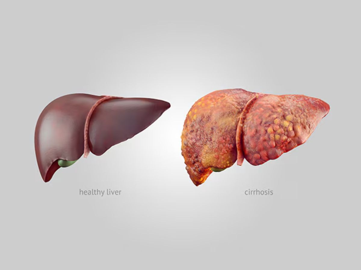 Liver Cirrhosis: कोल्ड ड्रिंक और पैकेटबंद जूस भी फैटी लिवर के लिए जिम्मेदार, इन शुरुआती संकेतों को न करें इग्नोर