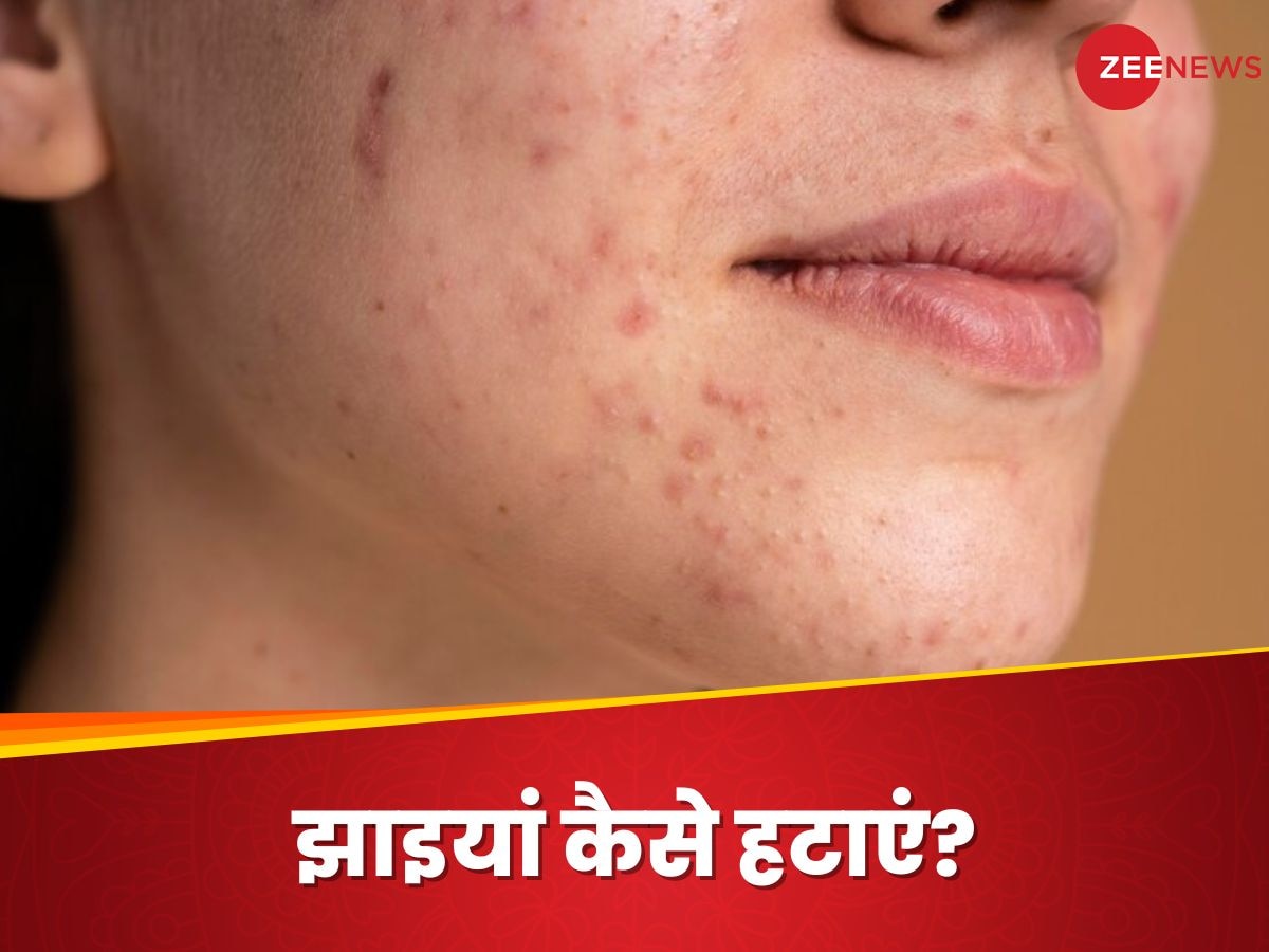 Pigmentation: झाइयों ने बिगाड़ दी है शक्ल? ग्लो वापस लाने में मदद करेगा ये हेल्दी ऑयल