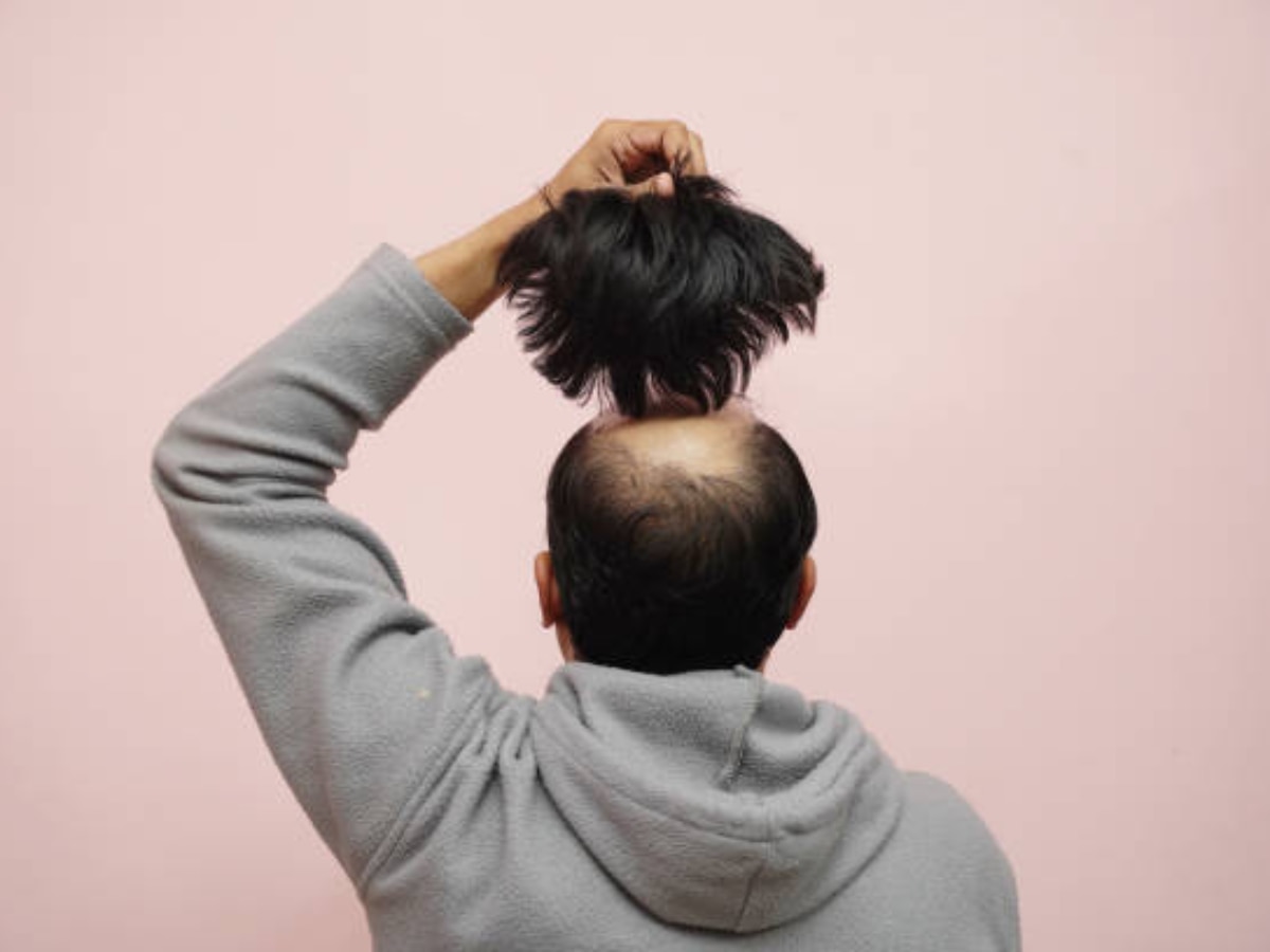 Causes of Hair Loss: शरीर में इस विटामिन की कमी से उड़ने लगते हैं सिर के बाल, 20 की उम्र में दिखने लगते हैं 40 के 