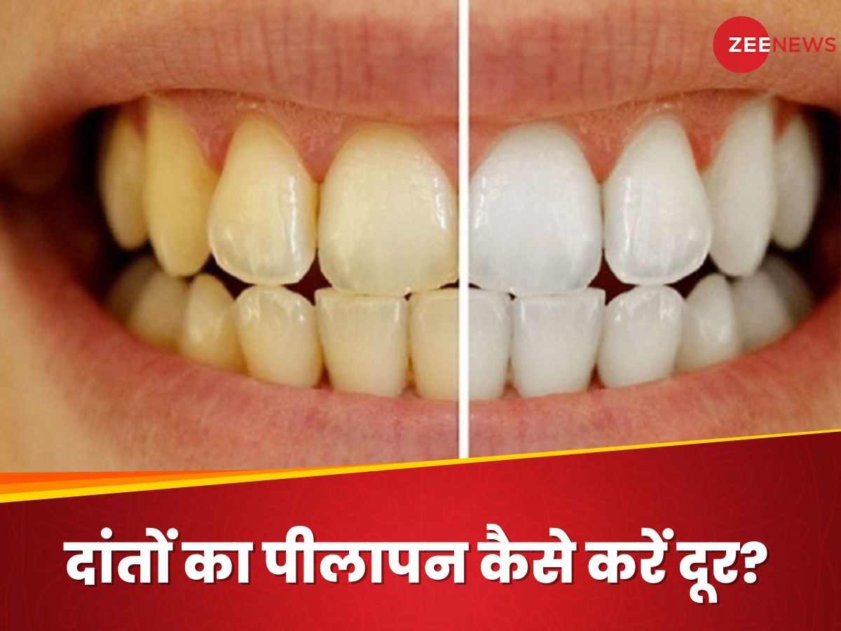 Teeth Whitening: दांतों के पीलेपन ने छीन लिया आपका कॉन्फिडेंस? इस तरह वापस पाएं मोतियों जैसी चमक