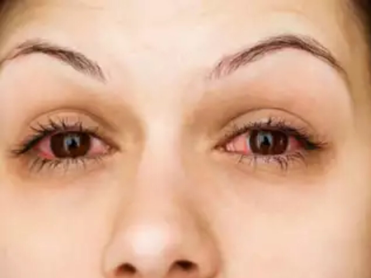 Eye Infection Remedies: मानसून के कारण बढ़नें लगते हैं आंखों के संक्रमण के ये खतरे, जानें इसके बचाव और उपाय