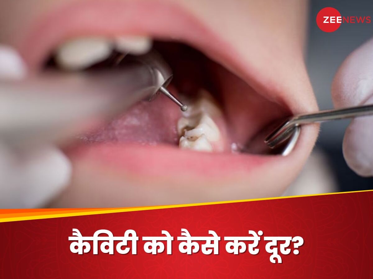 Teeth Cavity: दांतों की सड़न के कारण बंद रखना पड़ता है मुंह? जानिए कैसे पाएं 'कैविटी फ्री स्माइल'