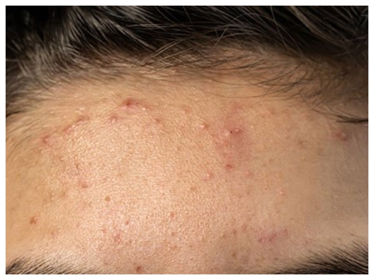 Forehead Acne: माथे पर निकल आए हैं मुहांसे? ये घरेलू उपाय हैं कारगर, तुरंत करते हैं असर