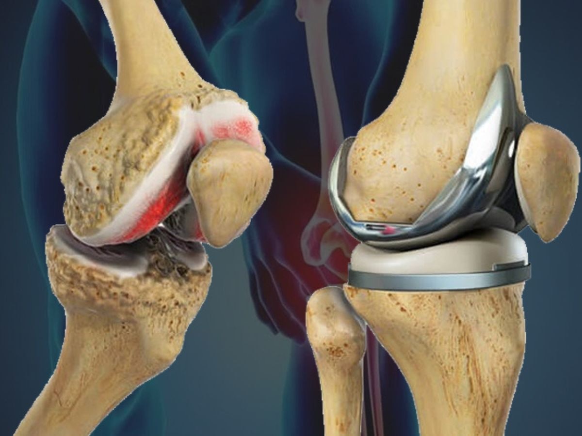 घुटने का दर्द हो रहा है असहनीय? कहीं ये Knee Replacement Surgery का संकेत तो नहीं