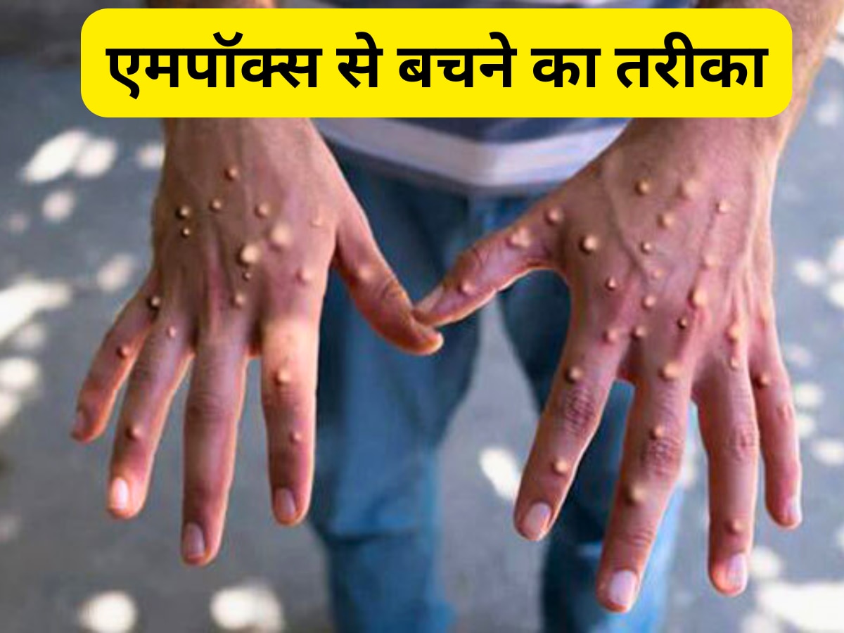 Mpox Symptoms:  इन 7 मामूली लक्षणों के साथ बॉडी को कंकाल बना रहा एमपॉक्स, ले ली 570 जान, बचने का सिर्फ एक रास्ता!