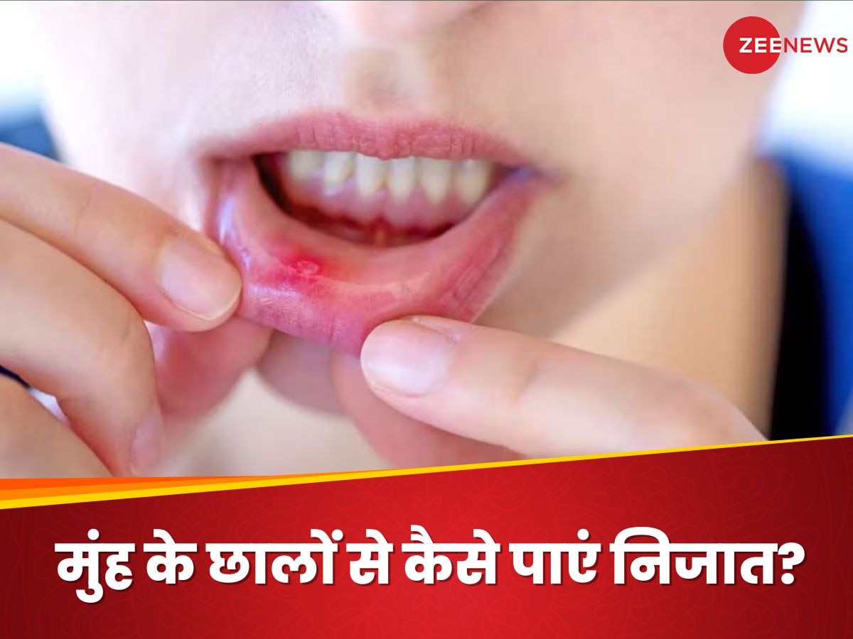 Mouth Ulcer: मुंह के छालों की वजह से भोजन करना हुआ मुश्किल, चुटकियों में कैसे पाएं राहत