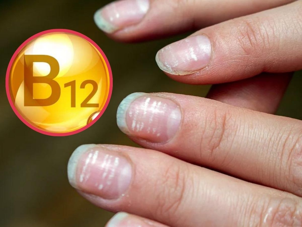 Vitamin B12 Deficiency: विटामिन B12 की कमी होने पर नाखूनों से इस तरह मिलते हैं संकेत, इग्नोर किया तो शरीर हो जाएगा खोखला!