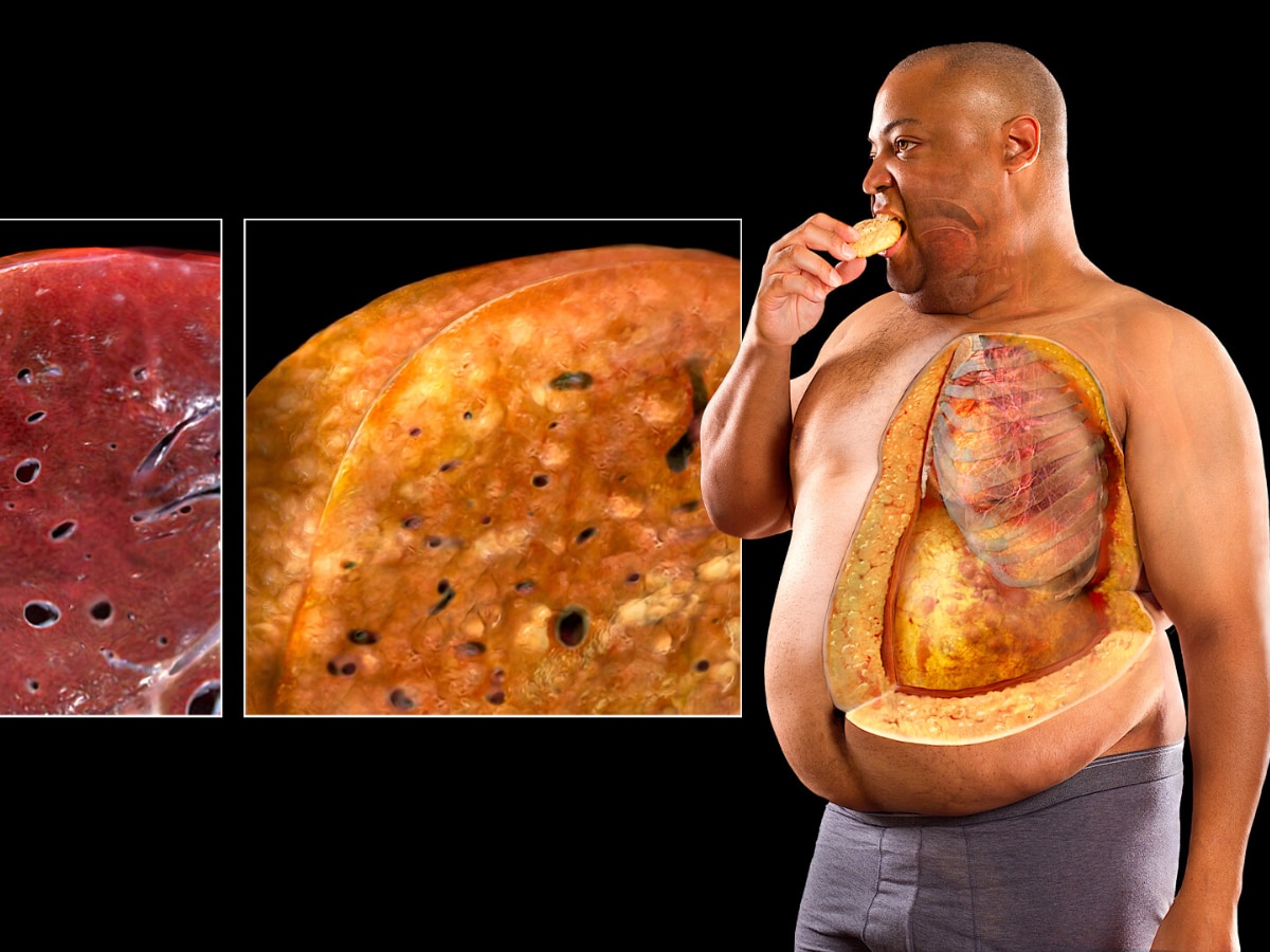 Fatty Liver: भ्रम में ना रहे! शराब नहीं पीते तो लिवर है हेल्दी, 5 फूड्स जहर से कम नहीं, गले से उतरते ही सड़ाने लगते हैं Liver