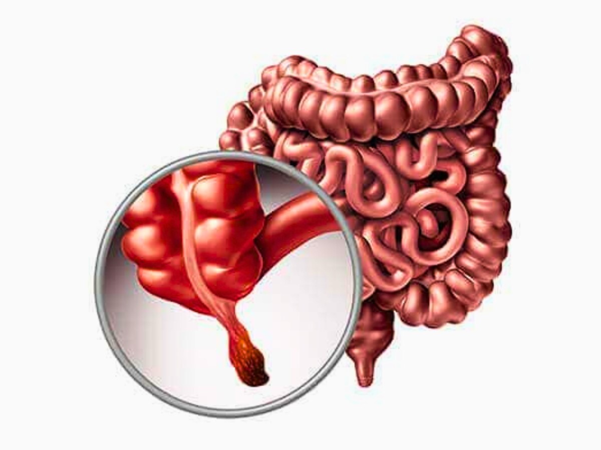 अपेंडिक्स में कैंसर की गांठ बनने पर दिखते हैं ये 5 लक्षण, इस उम्र के लोग ज्यादा रहे सतर्क, डॉ. ने दी चेतावनी