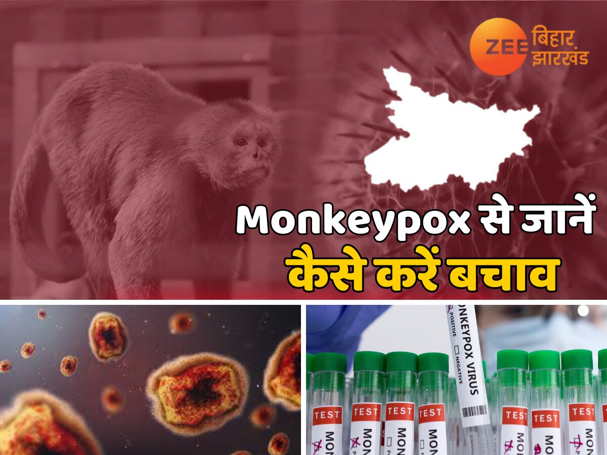 Monkeypox से कैसे करें बचाव, डॉ.वीके मोंगा ने समझिए मरीजों का कैसे रखें ध्यान