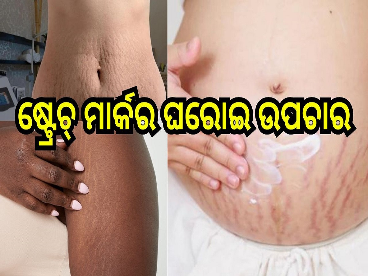 Stretch Marks: ଷ୍ଟ୍ରେଚ୍ ମାର୍କକୁ ନେଇ ଚିନ୍ତାରେ ଅଛନ୍ତି, ଡାକ୍ତର କହିଲେ ଏହାର ଘରୋଇ ଉପଚାର...